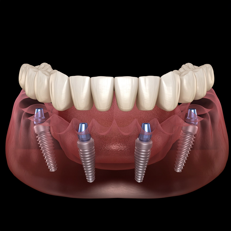 DSA Dental Clinic all-on-4