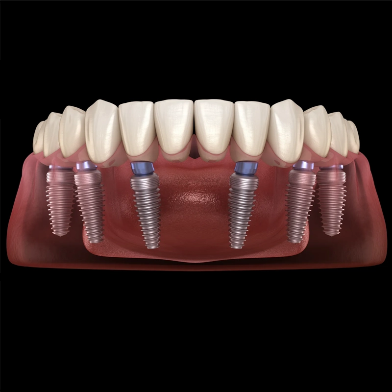 DSA Dental Clinic all-on-6