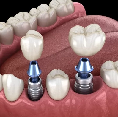 Implant DSA Dental Clinic